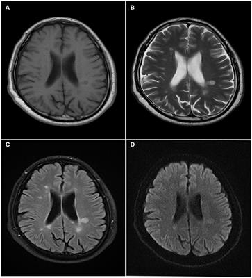 Progressive Multifocal Leukoencephalopathy Diagnosed by Metagenomic Next-Generation Sequencing of Cerebrospinal Fluid in an HIV Patient